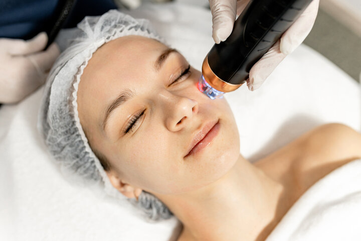 Microneedling