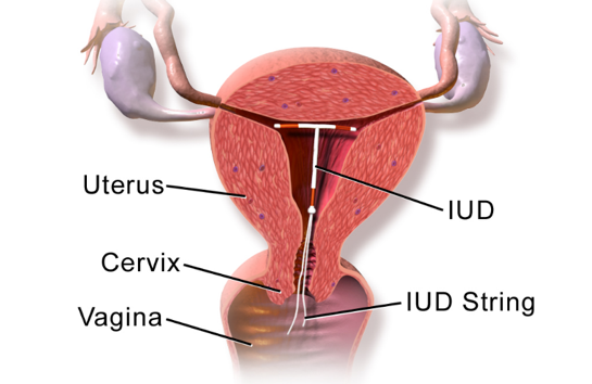 Understanding Intrauterine Devices